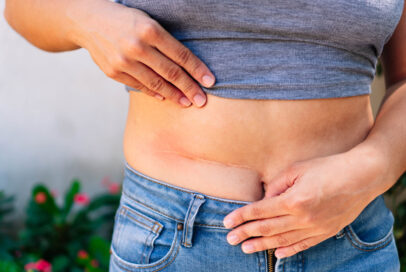 Scar Revision Surgery